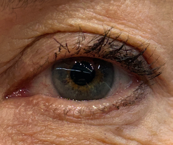 Intervento di Cataratta a Bressanone